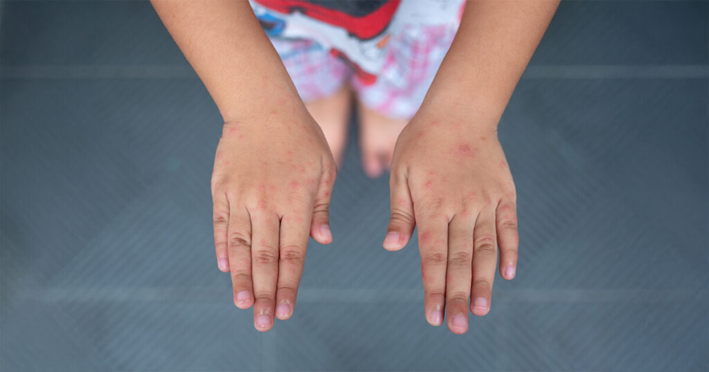 hand foot mouth disease