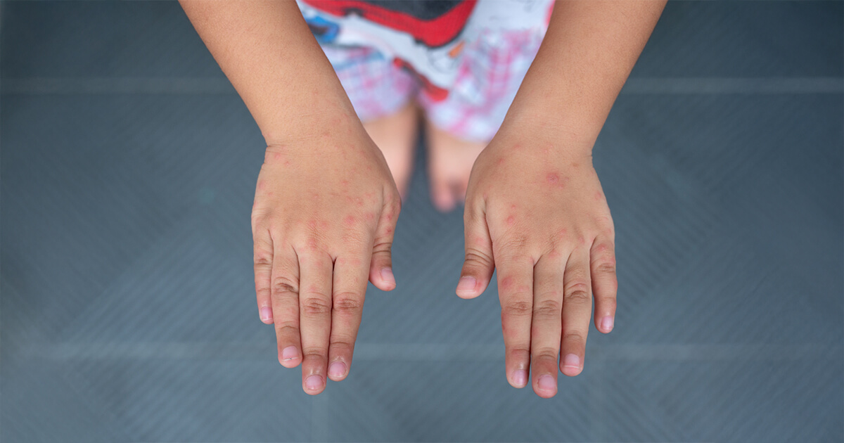 hand foot mouth disease