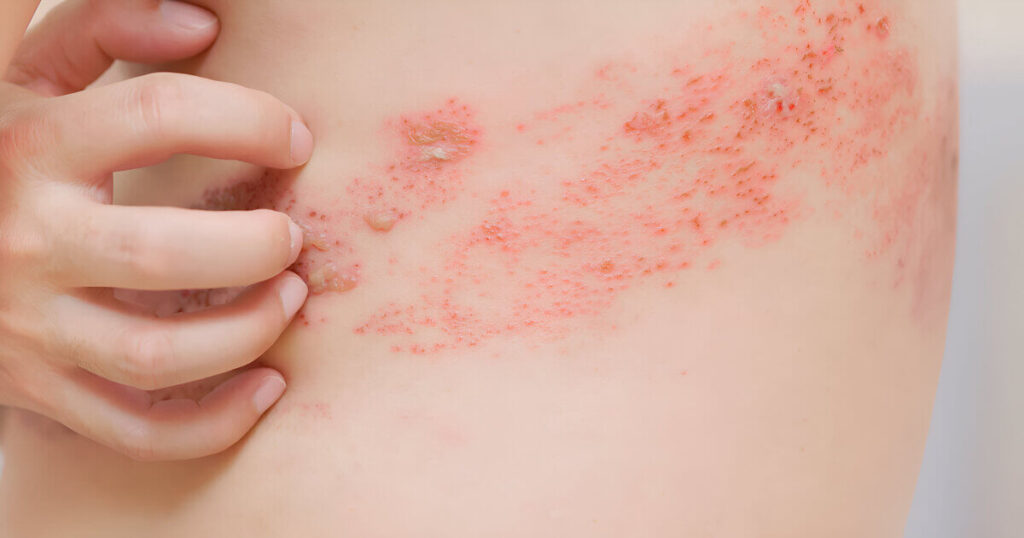 herpes zoster